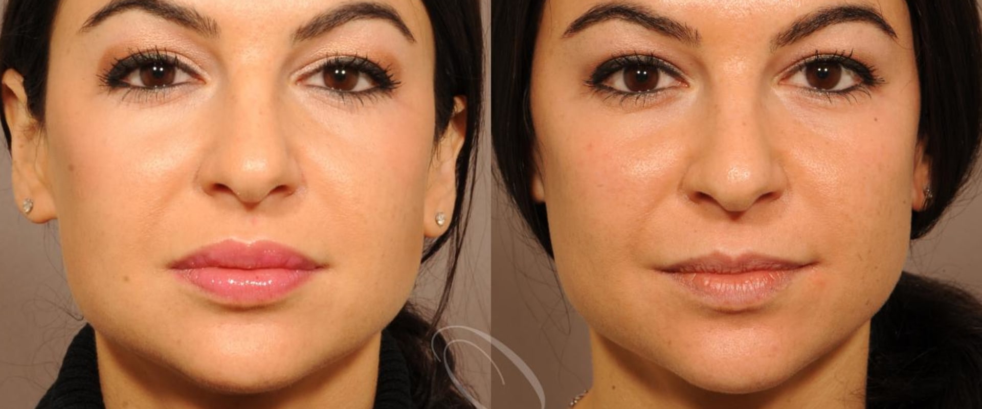 Fillers for face near me
