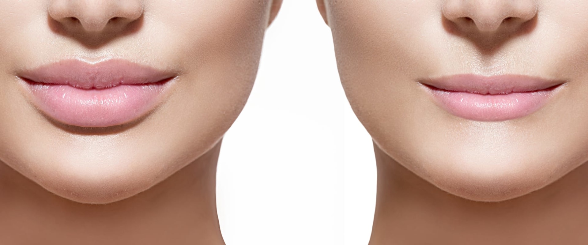 How Long Does it Take for Dermal Fillers to Settle?