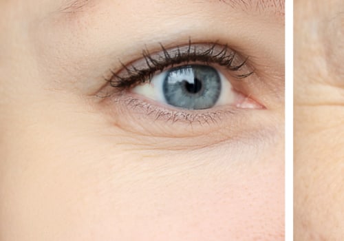 Dermal Fillers vs Botox: Which is Better for Wrinkles?