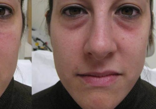 Are Dermal Fillers Safe? An Expert's Perspective