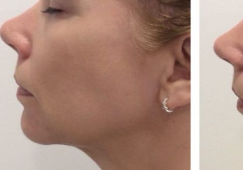 Can Filler Lift Your Jawline?